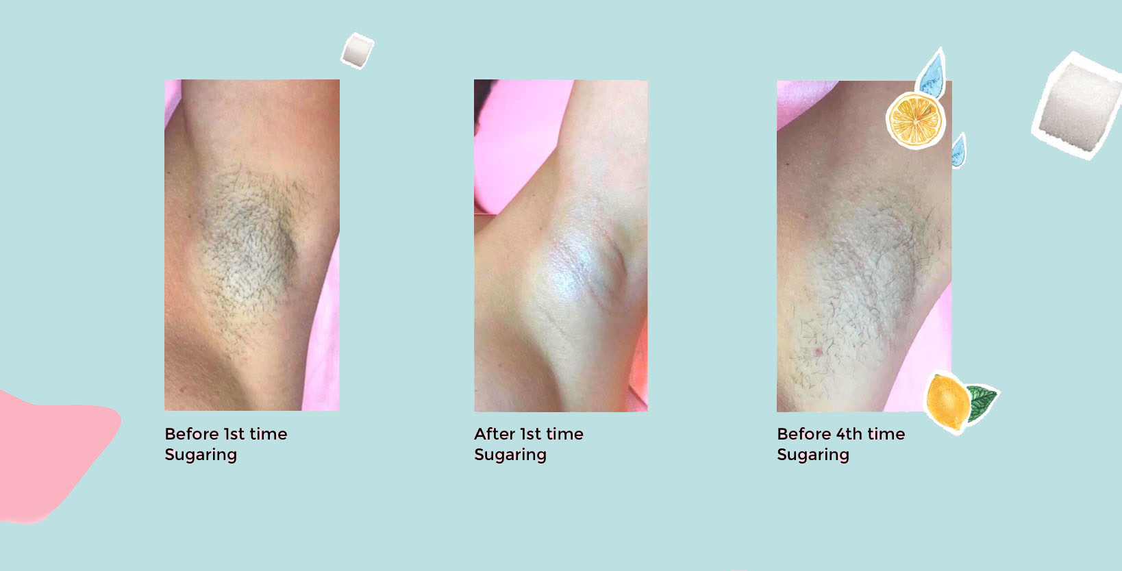 Arm Hands Sugaring hair removal by Sugaring NYC Franchise