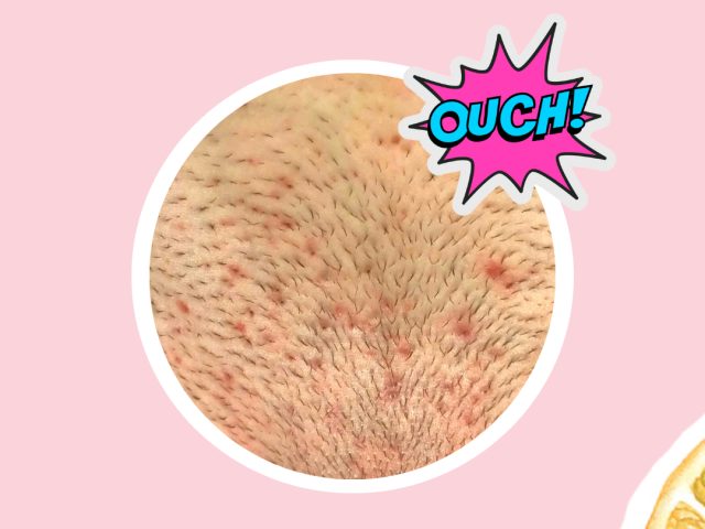 How to Prevent Ingrown Hairs, According to Estheticians
