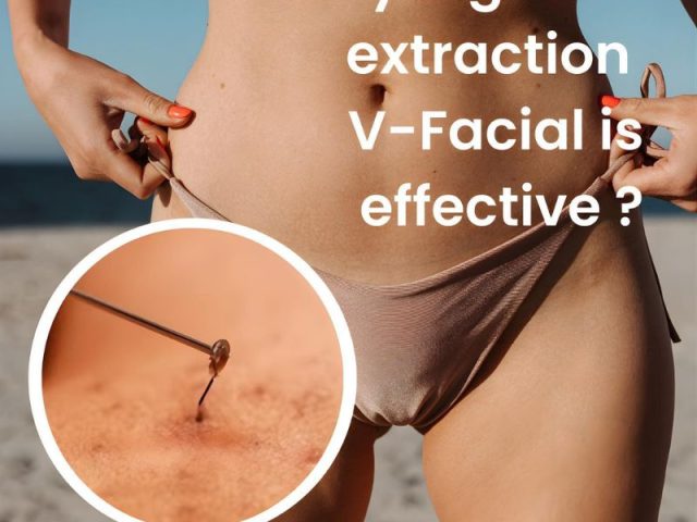 Tired of Battling Ingrown Hairs?