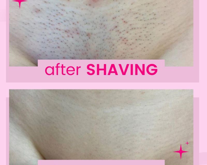 Get Smoother Skin with Sugaring: Say Goodbye to Stubble!