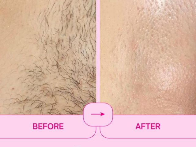 Enjoy Smooth, Redness-Free Skin with Brazilian Sugaring!