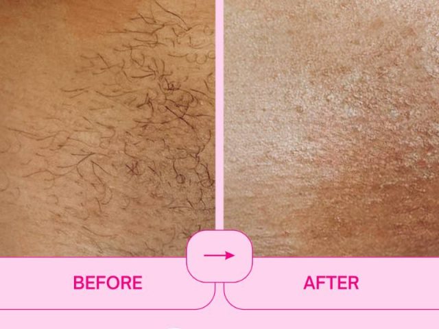 Benefits of Bikini Sugaring