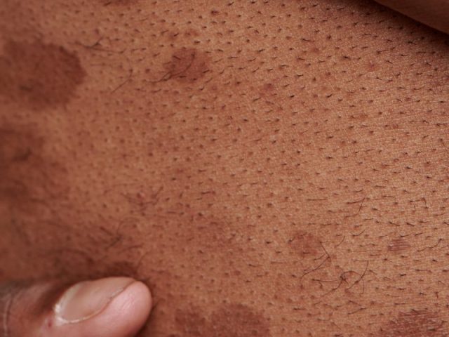 How Sugaring Helps with Hyperpigmentation Over Time: A Gentle Solution for Clearer Skin