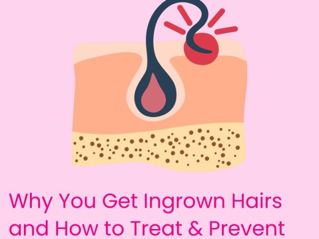 Understanding Ingrown Hairs: Causes, Treatments, and Prevention