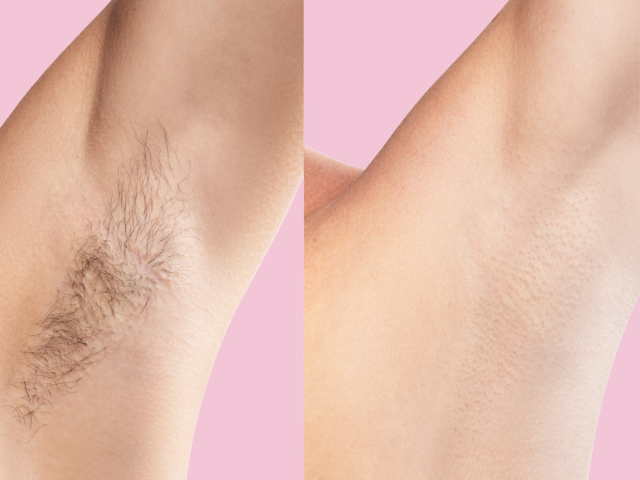 What Is Sugaring? Discover the Natural Hair Removal Method Everyone’s Talking About